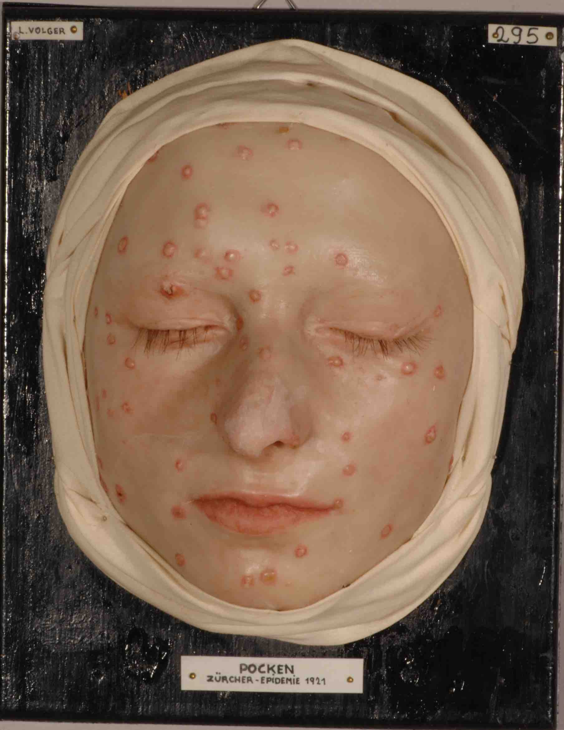 1921年苏黎世天花疫情期间，感染天花的Gertrud P.的面部蜡模。