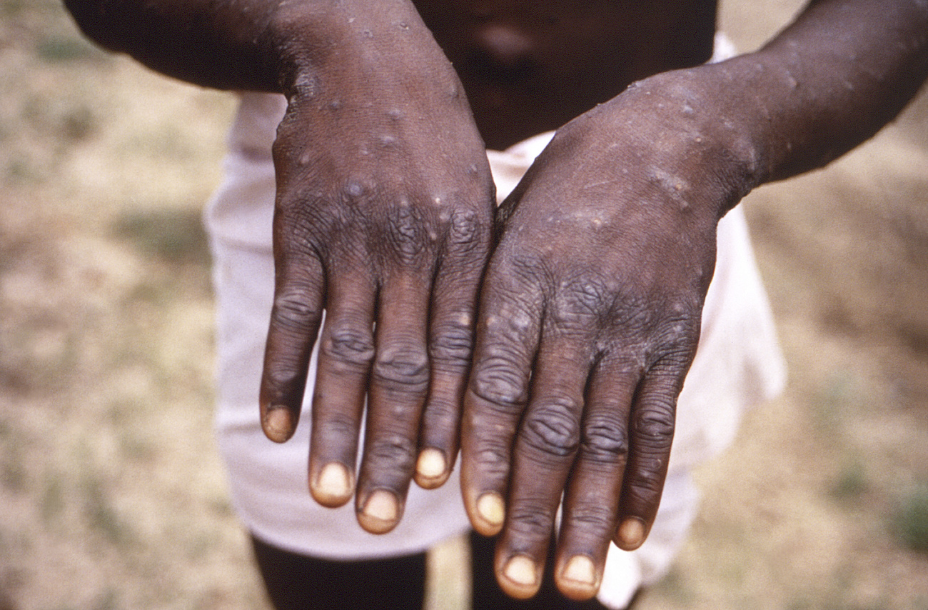 mani con segni di mpox